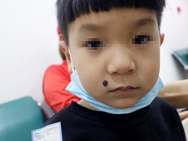 黑毛痣越长越大怎么办?